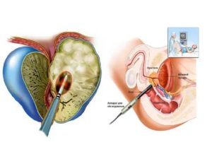 Мочевой свищ и простата
