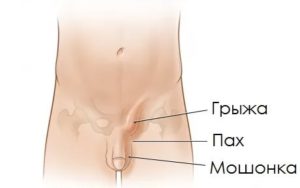 Что болит когда у тебя рак паха