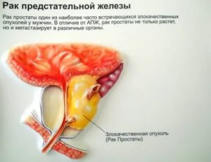 Причины психологические возникновения рака предстательной железы