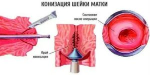 Конизация шейки матки стоимость в онкологии донецкой области