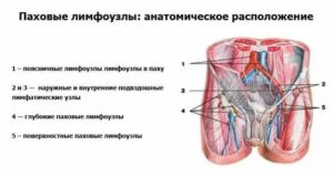 Метастатическое поражение лимфоузлов паховой области