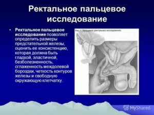 Техника пальцевого исследования предстательной железы
