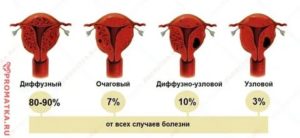 Внутренний эндометриоз диффузно-узловая форма что это такое