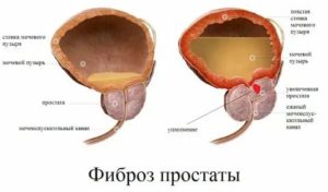 Парауретральный фиброз с кальцинозом предстательной железы