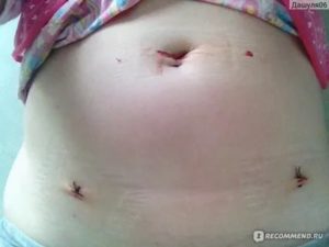 Почему не заживает шов после операции на яичнике
