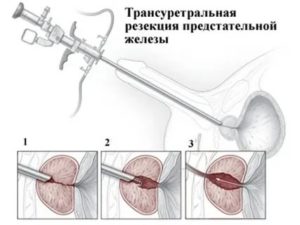 Можно ли посещать баню после удаления рака простаты