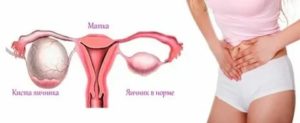 Почему киста болит после менструации