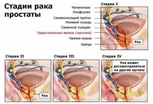Лечение рака простаты 4 степени асд