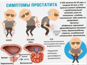 Может ли болеть спина при заболевании простаты