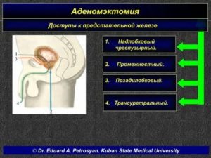 Осложнения после аденомэктомии простаты