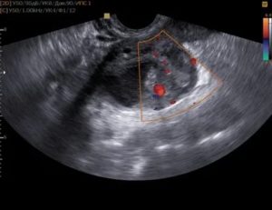 Можно ли на узи определить опухоль яичников
