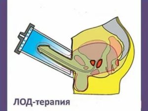 Прилив крови к простате массаж