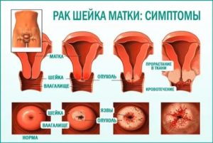 Кондиломы на шейке матки это рак