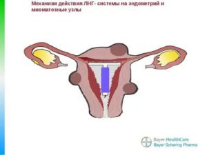 Как растет эндометрий на противозачаточных