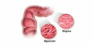 Чем лечить гонококковый проктит