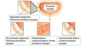 Как лечить хронический цистит при менопаузе