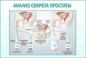 Уролог не смог взять сок простаты
