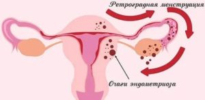 Что такое ретроградными менструациями