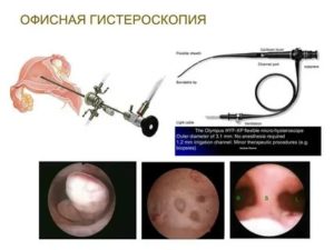 Офисная гистероскопия что это такое в гинекологии