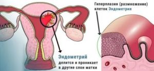 Как уменьшить эндометрий при менопаузе народными средствами