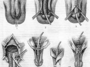 Какую операция делают мужчинам на половом органе