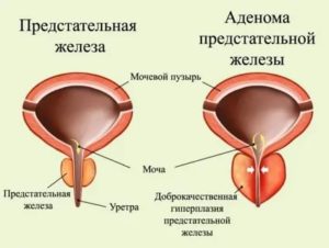 Можно ли есть чеснок при аденоме предстательной железы