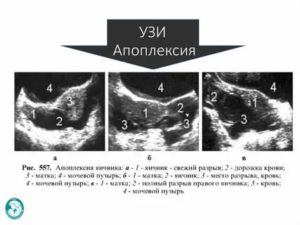 Можно ли забеременеть после операции апоплексии яичника