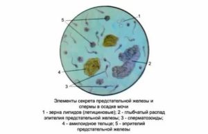 Лецитиновые зерна в моче после массажа простаты