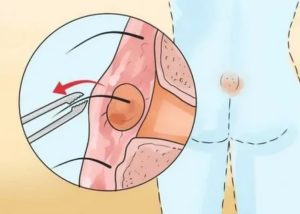 Что такое свищ на половом члене после операции