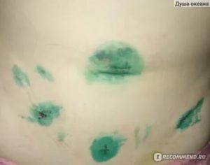 Почему не заживает шов после операции на яичнике