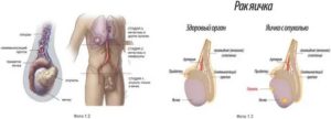 Что если появилась маленькая опухоль на яичке