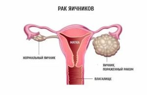 Может ли быть рак яичника у подростков