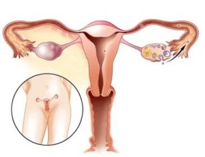 Почему болят яичники у женщин при климаксе