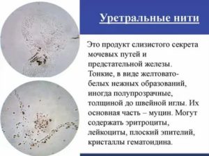 При простатите в моче гнойные нити