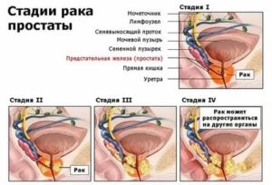 Клевер при раке простаты