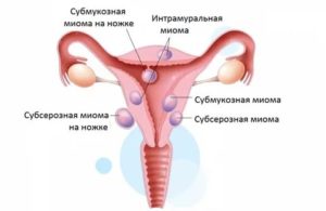 Может ли при климаксе матка быть в тонусе