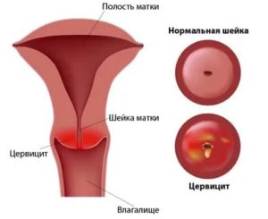 Что такое уреаплазменный цервицит