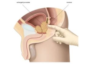 Положение для пальпации предстательной железы