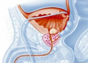 Кровотечение при простатите лечение