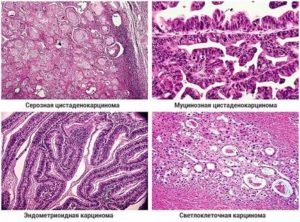 Что показывает гистология при раке яичников