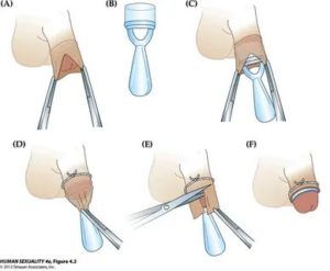 Помогает ли обрезание при простатите