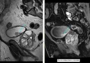 Кт и мрт почек мочевого пузыря простаты