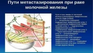 Лимфаденэктомия при раке молочной железы