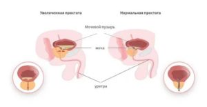 Увеличена простата в 2 раза как лечить хронический простатита у мужчин