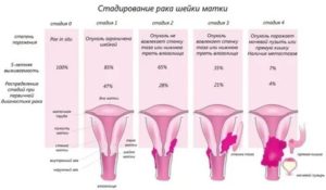 Рак шейки матки покалывание