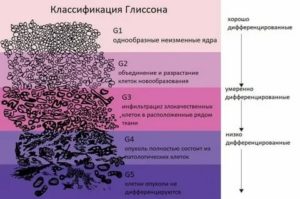 Умеренно-дифференцированная аденокарцинома предстательной железы что это такое