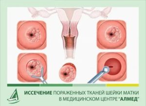 Сколько по времени делают операцию на шейки матки