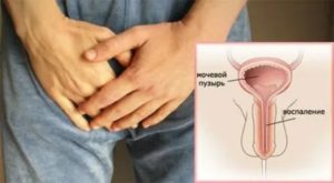 Покраснение головки из-за хронического простатита