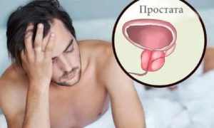 Половая жизнь при аденоме простаты у мужчин симптомы лечение