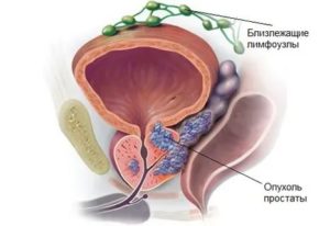 Suspicio tumor предстательной железы